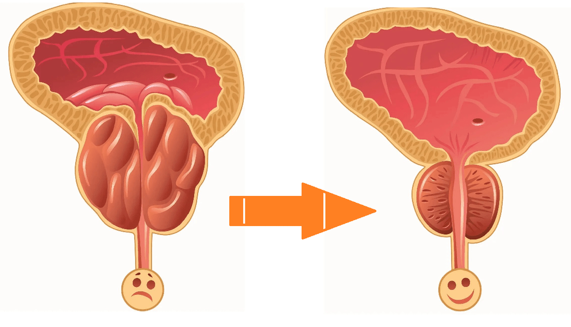 Uromexil Forte účinok na prostatu s prostatitídou a adenomom