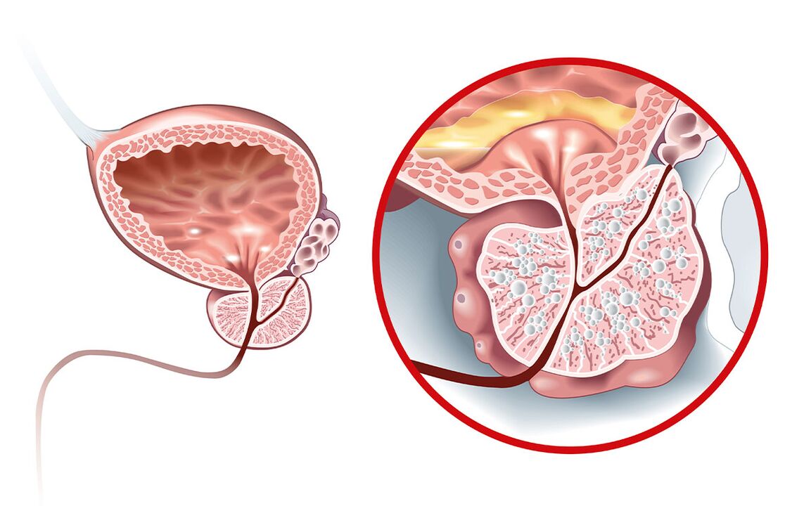 Čo sa stane s prostatou s adenomom a prostatitídou