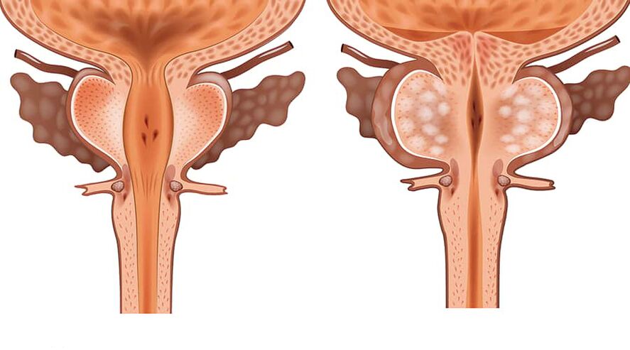 porovnanie zdravého a zapáleného adenómu