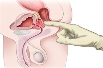 Masáž prostaty na liečbu chronickej prostatitídy