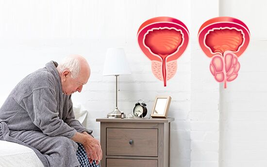 prostatitída u muža